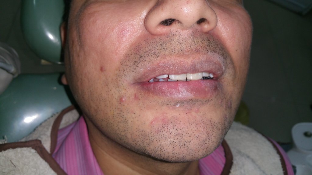 After Treatment 1