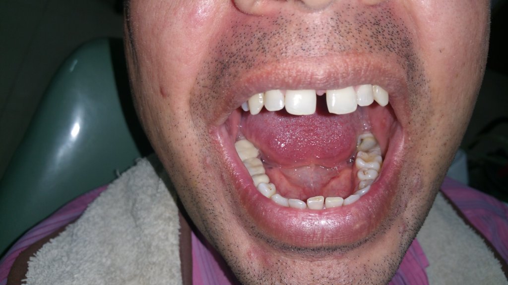 Before Treatment 1
